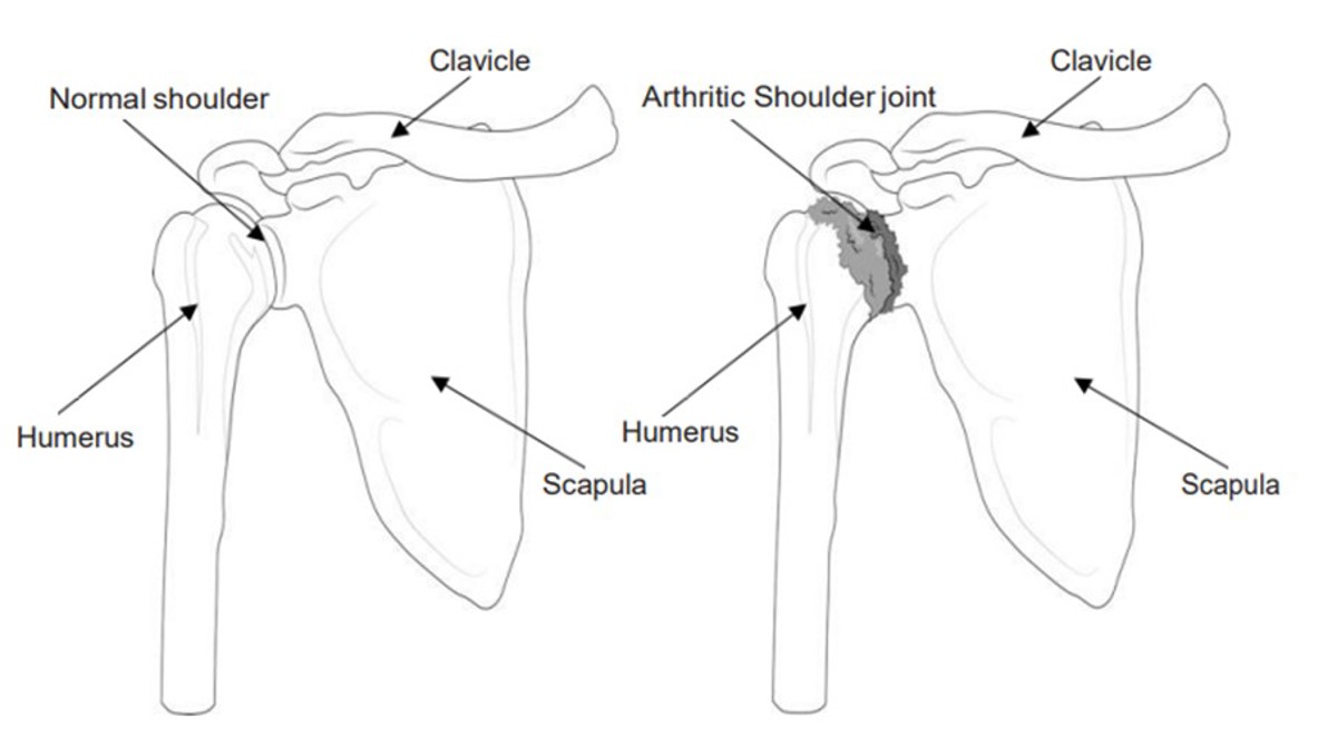 Shoulder Bones Showing Arthritic Joint